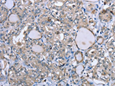 The image on the left is immunohistochemistry of paraffin-embedded Human thyroid cancer tissue using CSB-PA258899(FCAR Antibody) at dilution 1/20, on the right is treated with fusion protein. (Original magnification: ×200)
