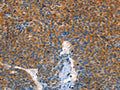The image on the left is immunohistochemistry of paraffin-embedded Human liver cancer tissue using CSB-PA258902(AUP1 Antibody) at dilution 1/50, on the right is treated with fusion protein. (Original magnification: ×200)