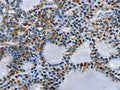 The image on the left is immunohistochemistry of paraffin-embedded Human thyroid cancer tissue using CSB-PA259179(BCOR Antibody) at dilution 1/15, on the right is treated with fusion protein. (Original magnification: ×200)
