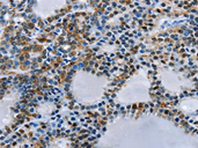 The image on the left is immunohistochemistry of paraffin-embedded Human thyroid cancer tissue using CSB-PA259179(BCOR Antibody) at dilution 1/15, on the right is treated with fusion protein. (Original magnification: ×200)