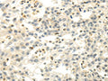 The image on the left is immunohistochemistry of paraffin-embedded Human breast cancer tissue using CSB-PA259822(CDKN1A Antibody) at dilution 1/30, on the right is treated with fusion protein. (Original magnification: ×200)