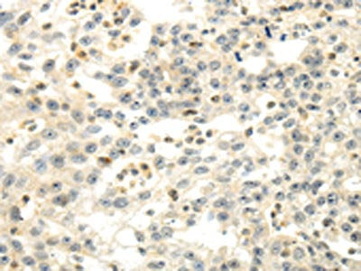 The image on the left is immunohistochemistry of paraffin-embedded Human breast cancer tissue using CSB-PA259822(CDKN1A Antibody) at dilution 1/30, on the right is treated with fusion protein. (Original magnification: ×200)