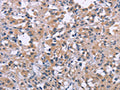 The image on the left is immunohistochemistry of paraffin-embedded Human thyroid cancer tissue using CSB-PA259888(DUSP1 Antibody) at dilution 1/30, on the right is treated with synthetic peptide. (Original magnification: X200)