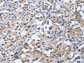 The image on the left is immunohistochemistry of paraffin-embedded Human thyroid cancer tissue using CSB-PA260295(CEACAM3 Antibody) at dilution 1/60, on the right is treated with fusion protein. (Original magnification: ×200)