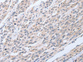 The image on the left is immunohistochemistry of paraffin-embedded Human esophagus cancer tissue using CSB-PA261024(TNK2 Antibody) at dilution 1/20, on the right is treated with fusion protein. (Original magnification: ×200)