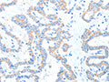 The image on the left is immunohistochemistry of paraffin-embedded Human thyroid cancer tissue using CSB-PA261035(ADAM17 Antibody) at dilution 1/15, on the right is treated with fusion protein. (Original magnification: ×200)