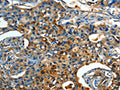 The image on the left is immunohistochemistry of paraffin-embedded Human lung cancer tissue using CSB-PA261047(ORM1 Antibody) at dilution 1/15, on the right is treated with fusion protein. (Original magnification: ×200)