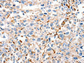 The image on the left is immunohistochemistry of paraffin-embedded Human esophagus cancer tissue using CSB-PA261651(DUSP14 Antibody) at dilution 1/20, on the right is treated with fusion protein. (Original magnification: ×200)