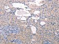 The image on the left is immunohistochemistry of paraffin-embedded Human cervical cancer tissue using CSB-PA261772(ABCF1 Antibody) at dilution 1/40, on the right is treated with fusion protein. (Original magnification: ×200)