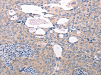 The image on the left is immunohistochemistry of paraffin-embedded Human cervical cancer tissue using CSB-PA261772(ABCF1 Antibody) at dilution 1/40, on the right is treated with fusion protein. (Original magnification: ×200)