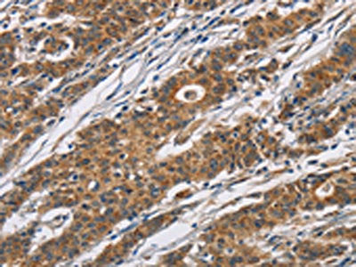 The image on the left is immunohistochemistry of paraffin-embedded Human gastic cancer tissue using CSB-PA263571(CYP21A2 Antibody) at dilution 1/60, on the right is treated with fusion protein. (Original magnification: ×200)