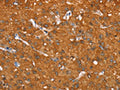 The image on the left is immunohistochemistry of paraffin-embedded Human liver cancer tissue using CSB-PA263631(AKR1C4 Antibody) at dilution 1/25, on the right is treated with fusion protein. (Original magnification: ×200)