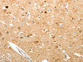The image on the left is immunohistochemistry of paraffin-embedded Human brain tissue using CSB-PA263723(PVALB Antibody) at dilution 1/20, on the right is treated with fusion protein. (Original magnification: ×200)