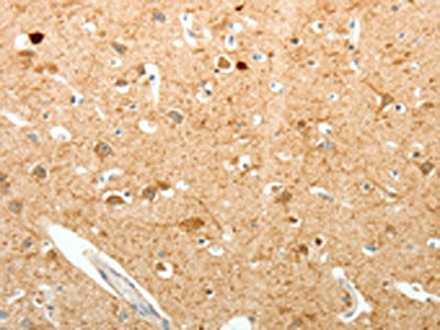 The image on the left is immunohistochemistry of paraffin-embedded Human brain tissue using CSB-PA263723(PVALB Antibody) at dilution 1/20, on the right is treated with fusion protein. (Original magnification: ×200)