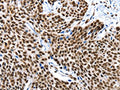 The image on the left is immunohistochemistry of paraffin-embedded Human esophagus cancer tissue using CSB-PA263929(KLK7 Antibody) at dilution 1/10, on the right is treated with fusion protein. (Original magnification: ×200)