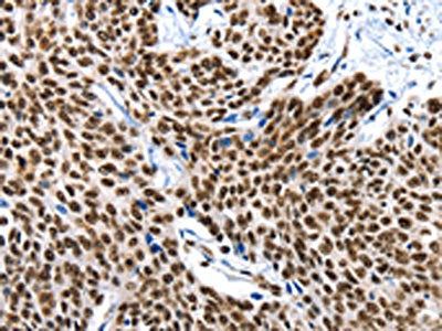 The image on the left is immunohistochemistry of paraffin-embedded Human esophagus cancer tissue using CSB-PA263929(KLK7 Antibody) at dilution 1/10, on the right is treated with fusion protein. (Original magnification: ×200)