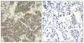 Immunohistochemical analysis of paraffin-embedded human breast carcinoma tissue using Jak2(Ab-570) Antibody(left) or the same antibody preincubated with blocking peptide(right).
