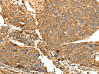 The image on the left is immunohistochemistry of paraffin-embedded Human liver cancer tissue using CSB-PA265153(SYT11 Antibody) at dilution 1/30, on the right is treated with fusion protein. (Original magnification: ×200)