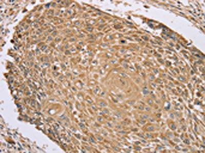 The image on the left is immunohistochemistry of paraffin-embedded Human lung cancer tissue using CSB-PA265607(RNF148 Antibody) at dilution 1/45, on the right is treated with synthetic peptide. (Original magnification: ×200)