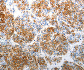 Immunohistochemical analysis of paraffin-embedded Human tonsil cancer tissue using at dilution 1/40.