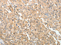 The image on the left is immunohistochemistry of paraffin-embedded Human ovarian cancer tissue using CSB-PA265957(MAP4 Antibody) at dilution 1/10, on the right is treated with fusion protein. (Original magnification: ×200)