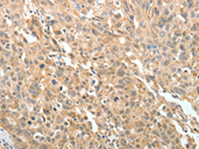 The image on the left is immunohistochemistry of paraffin-embedded Human ovarian cancer tissue using CSB-PA265957(MAP4 Antibody) at dilution 1/10, on the right is treated with fusion protein. (Original magnification: ×200)