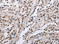The image on the left is immunohistochemistry of paraffin-embedded Human esophagus cancer tissue using CSB-PA266111(FN1 Antibody) at dilution 1/35, on the right is treated with fusion protein. (Original magnification: ×200)