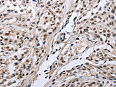 The image on the left is immunohistochemistry of paraffin-embedded Human esophagus cancer tissue using CSB-PA266111(FN1 Antibody) at dilution 1/35, on the right is treated with fusion protein. (Original magnification: ×200)