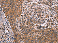 The image on the left is immunohistochemistry of paraffin-embedded Human cervical cancer tissue using CSB-PA266125(ING2 Antibody) at dilution 1/60, on the right is treated with fusion protein. (Original magnification: ×200)