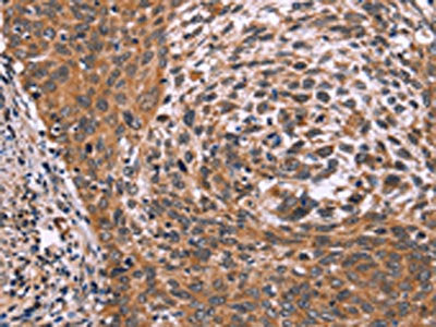 The image on the left is immunohistochemistry of paraffin-embedded Human cervical cancer tissue using CSB-PA266125(ING2 Antibody) at dilution 1/60, on the right is treated with fusion protein. (Original magnification: ×200)