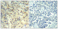 Immunohistochemical analysis of paraffin-embedded human lung carcinoma tissue using cofilin1(Phospho-Tyr139) Antibody(left) or the same antibody preincubated with blocking peptide(right).