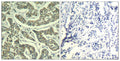 Immunohistochemical analysis of paraffin-embedded human breast carcinoma tissue using ATR(Ab-428) Antiobdy(left) or the same antibody preincubated with blocking peptide(right).