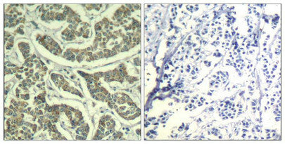 Immunohistochemical analysis of paraffin-embedded human breast carcinoma tissue using ATR(Ab-428) Antiobdy(left) or the same antibody preincubated with blocking peptide(right).