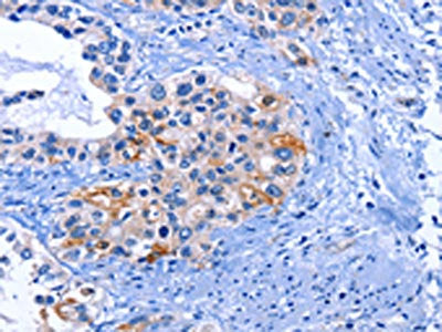 The image on the left is immunohistochemistry of paraffin-embedded Human cervical cancer tissue using CSB-PA267352(CDK2 Antibody) at dilution 1/25, on the right is treated with fusion protein. (Original magnification: ×200)