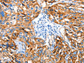 The image on the left is immunohistochemistry of paraffin-embedded Human esophagus cancer tissue using CSB-PA267569(AOX1 Antibody) at dilution 1/65, on the right is treated with fusion protein. (Original magnification: ×200)