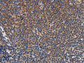 The image on the left is immunohistochemistry of paraffin-embedded Human Lymphoma tissue using CSB-PA267618(CCL23 Antibody) at dilution 1/50, on the right is treated with synthetic peptide. (Original magnification: ×200)