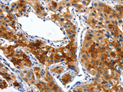 The image on the left is immunohistochemistry of paraffin-embedded Human lung cancer tissue using CSB-PA267624(ALPP Antibody) at dilution 1/50, on the right is treated with fusion protein. (Original magnification: ×200)