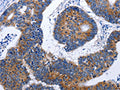 The image on the left is immunohistochemistry of paraffin-embedded Human colon cancer tissue using CSB-PA268035(EEF1G Antibody) at dilution 1/50, on the right is treated with fusion protein. (Original magnification: ×200)