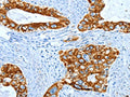 The image on the left is immunohistochemistry of paraffin-embedded Human cervical cancer tissue using CSB-PA268168(KRT40 Antibody) at dilution 1/50, on the right is treated with fusion protein. (Original magnification: X200)