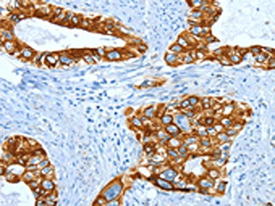 The image on the left is immunohistochemistry of paraffin-embedded Human cervical cancer tissue using CSB-PA268168(KRT40 Antibody) at dilution 1/50, on the right is treated with fusion protein. (Original magnification: X200)