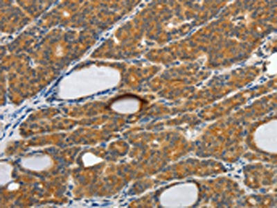 The image on the left is immunohistochemistry of paraffin-embedded Human thyroid cancer tissue using CSB-PA268599(CSF2 Antibody) at dilution 1/30, on the right is treated with fusion protein. (Original magnification: ×200)