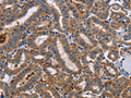 The image on the left is immunohistochemistry of paraffin-embedded Human thyroid cancer tissue using CSB-PA268874(TLR8 Antibody) at dilution 1/40, on the right is treated with fusion protein. (Original magnification: ×200)