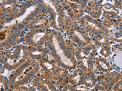The image on the left is immunohistochemistry of paraffin-embedded Human thyroid cancer tissue using CSB-PA268874(TLR8 Antibody) at dilution 1/40, on the right is treated with fusion protein. (Original magnification: ×200)