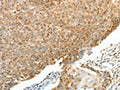 The image on the left is immunohistochemistry of paraffin-embedded Human cervical cancer tissue using CSB-PA269500(SPAG8 Antibody) at dilution 1/25, on the right is treated with fusion protein. (Original magnification: ×200)