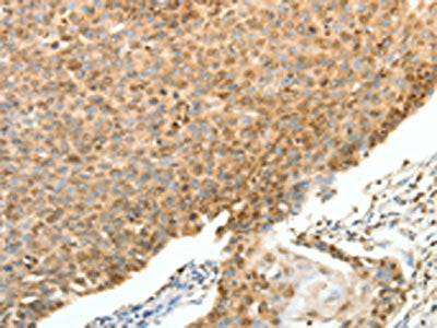 The image on the left is immunohistochemistry of paraffin-embedded Human cervical cancer tissue using CSB-PA269500(SPAG8 Antibody) at dilution 1/25, on the right is treated with fusion protein. (Original magnification: ×200)