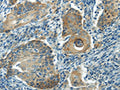 The image on the left is immunohistochemistry of paraffin-embedded Human cervical cancer tissue using CSB-PA270025(IL-20 Antibody) at dilution 1/35, on the right is treated with synthetic peptide. (Original magnification: ×200)