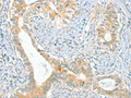 The image on the left is immunohistochemistry of paraffin-embedded Human cervical cancer tissue using CSB-PA271234(ACE Antibody) at dilution 1/80, on the right is treated with synthetic peptide. (Original magnification: ×200)