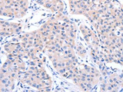 The image on the left is immunohistochemistry of paraffin-embedded Human lung cancer tissue using CSB-PA271275(ACTR3B Antibody) at dilution 1/15, on the right is treated with fusion protein. (Original magnification: ×200)