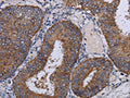 The image on the left is immunohistochemistry of paraffin-embedded Human colon cancer tissue using CSB-PA271484(NDUFA1 Antibody) at dilution 1/30, on the right is treated with fusion protein. (Original magnification: ×200)