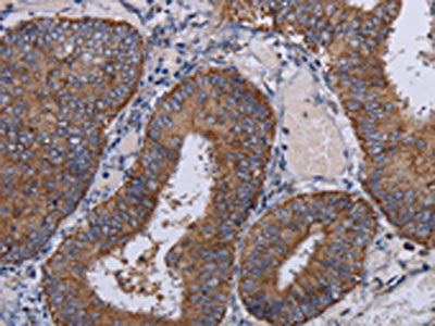 The image on the left is immunohistochemistry of paraffin-embedded Human colon cancer tissue using CSB-PA271484(NDUFA1 Antibody) at dilution 1/30, on the right is treated with fusion protein. (Original magnification: ×200)